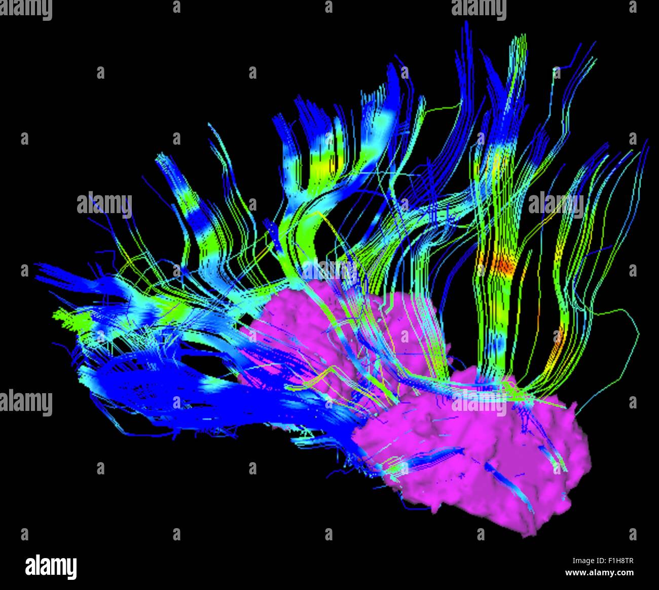I collegamenti tra il putamen e nel lobo frontale in un morbo di Parkinson cervello del paziente Foto Stock