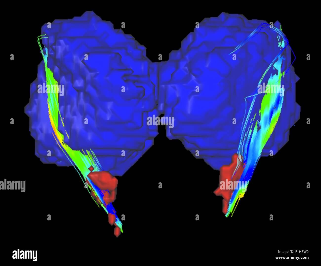 I collegamenti tra la substancia nigra e il talamo in un morbo di Parkinson cervello Foto Stock