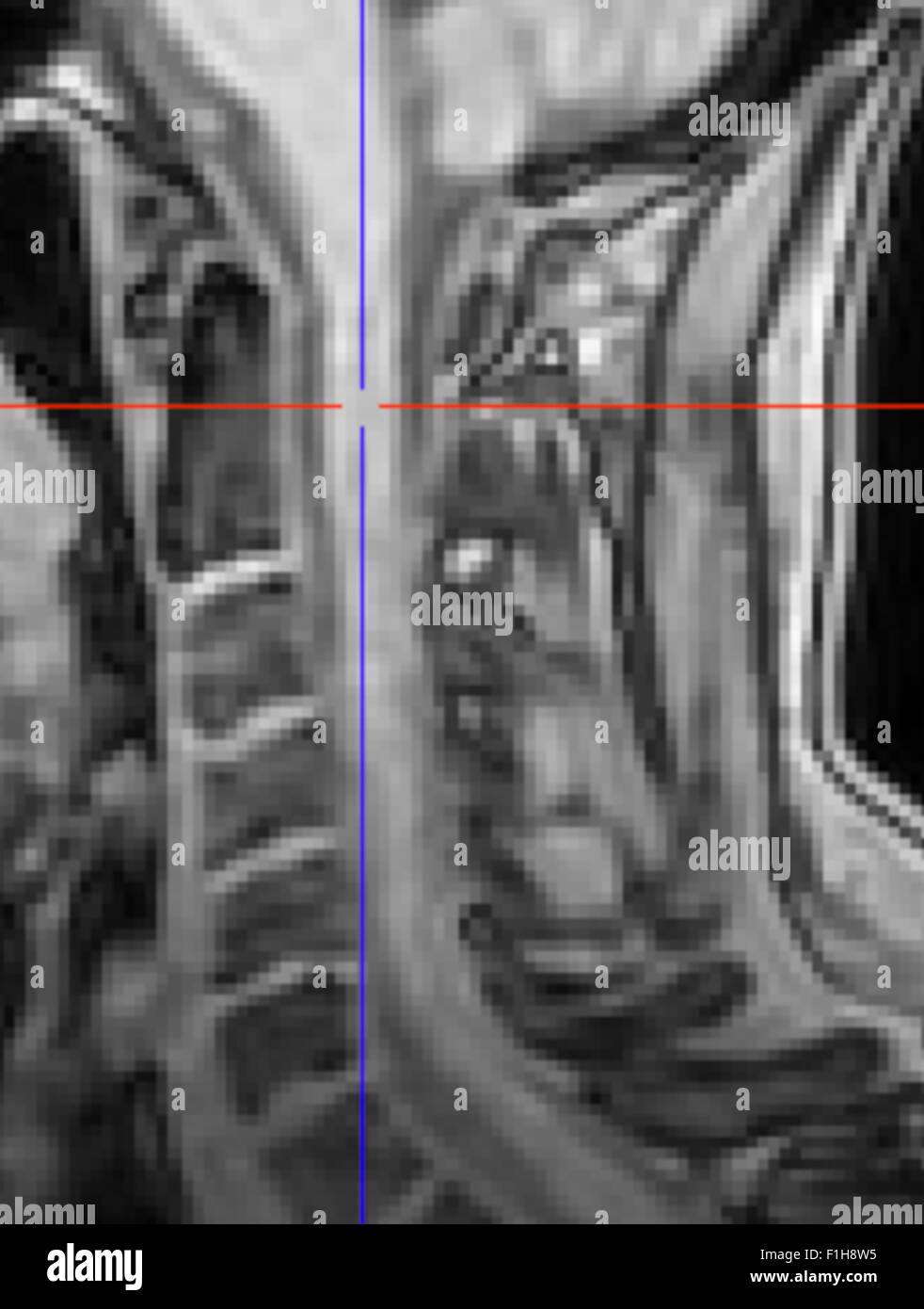 Il midollo spinale di un sano controllo. Anatomica per T1 immagine ponderata Foto Stock