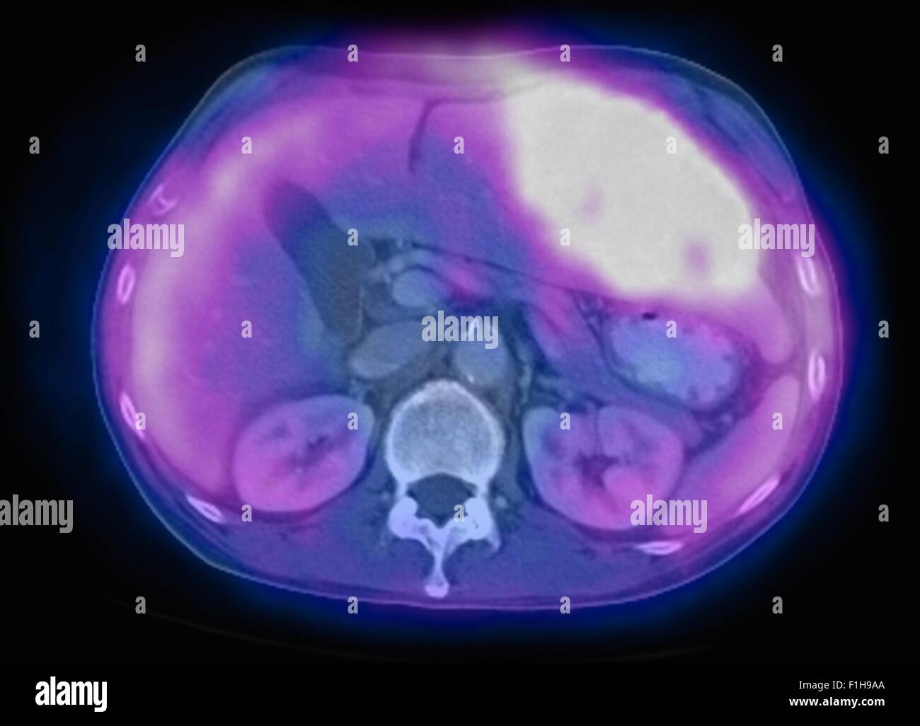Immagine co-registrato pet-ct studio modalità doppio scanner. Paziente più lesioni metastatiche del fegato e polmone Foto Stock