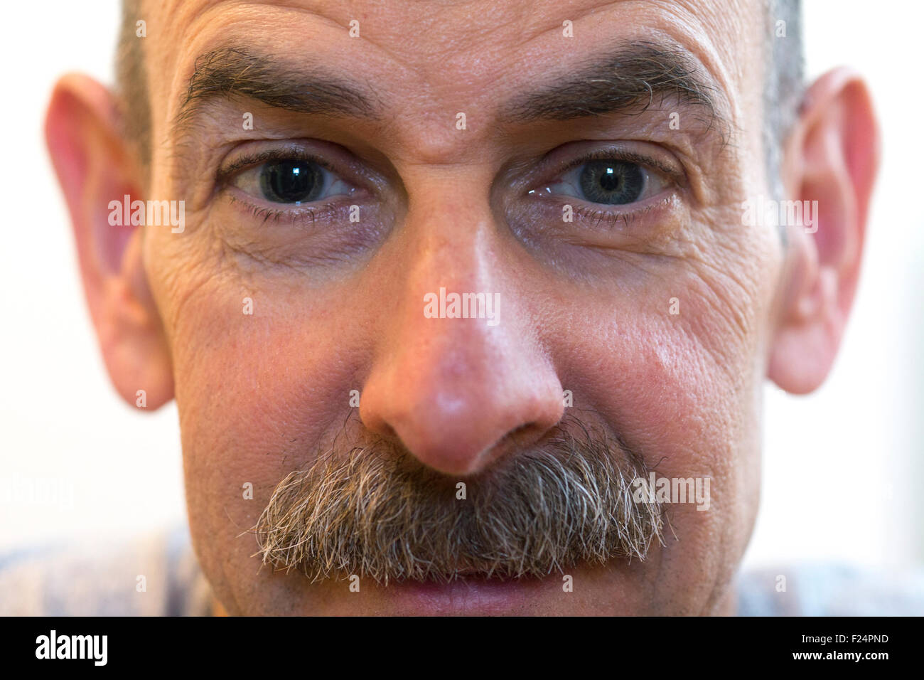 Uomo con alunni di diverse dimensioni dopo Tropicamide dilatazione di rinvio esame oculistico Foto Stock