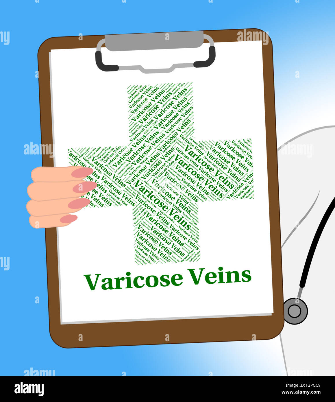 Vene varicose indicando il sistema circolatorio e ritorto Foto Stock