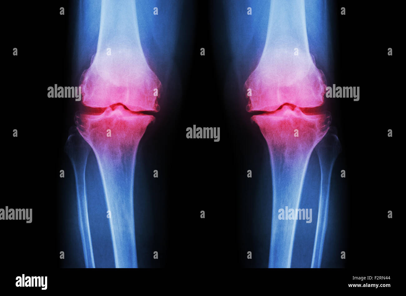 Osteoartrite del ginocchio OA ( ) del ginocchio. Film x-ray sia ginocchio ( vista frontale ) mostra giunto stretto spazio ( la cartilagine articolare la perdita ) , osteophy Foto Stock