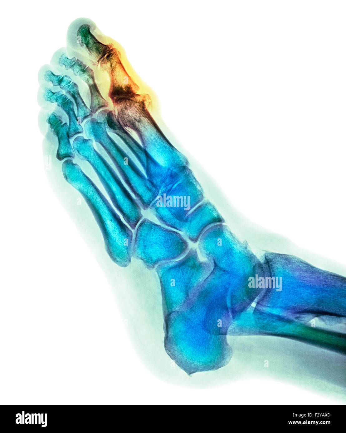 Degenerative deformazione del piede. Colorato X-ray di una sezione attraverso il piede di un 66-anno-vecchio paziente di sesso maschile con un grave cambiamento degenerativa nel metatarsophalangeal (MTP) giunto (evidenziato) dell'alluce (top). Il protocollo MTP giunti sono le articolazioni tra le ossa metatarsali del piede e le ossa prossimali (prossimale) delle falangi delle dita. Foto Stock
