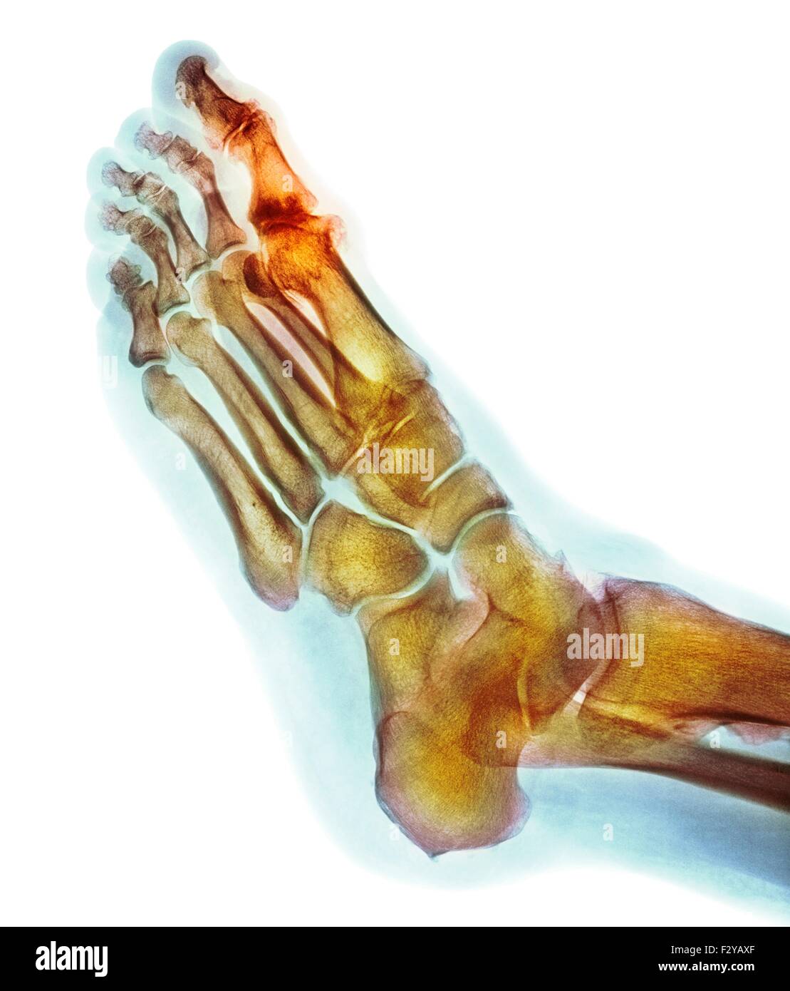 Degenerative deformazione del piede. Colorato X-ray di una sezione attraverso il piede di un 66-anno-vecchio paziente di sesso maschile con un grave cambiamento degenerativa nel metatarsophalangeal (MTP) giunto (evidenziato) dell'alluce (top). Il protocollo MTP giunti sono le articolazioni tra le ossa metatarsali del piede e le ossa prossimali (prossimale) delle falangi delle dita. Foto Stock