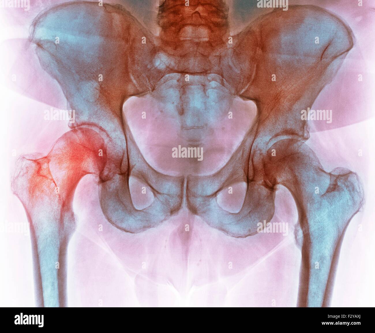 Anca prima di chirurgia sostitutiva dell'anca. Colorato X-ray di una sezione attraverso la regione pelvica di un 66-anno-vecchio paziente di sesso maschile con una articolazione dell'anca danneggiata (sinistra) prelevato prima del totale chirurgia sostitutiva dell'anca. Foto Stock