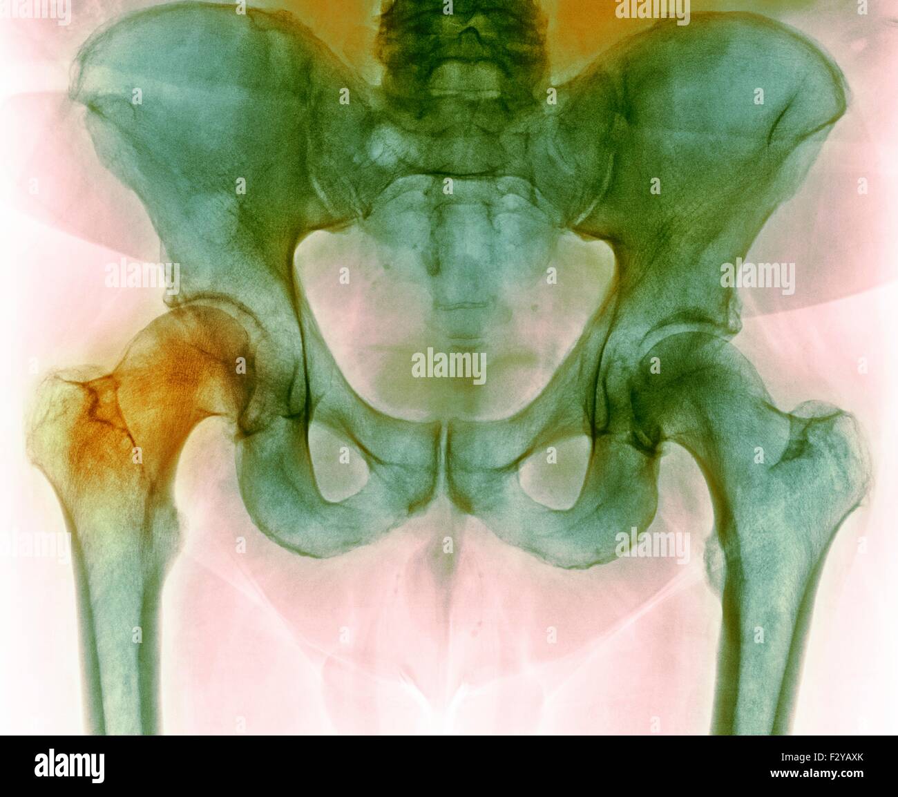 Anca prima di chirurgia sostitutiva dell'anca. Colorato X-ray di una sezione attraverso la regione pelvica di un 66-anno-vecchio paziente di sesso maschile con una articolazione dell'anca danneggiata (sinistra) prelevato prima del totale chirurgia sostitutiva dell'anca. Foto Stock