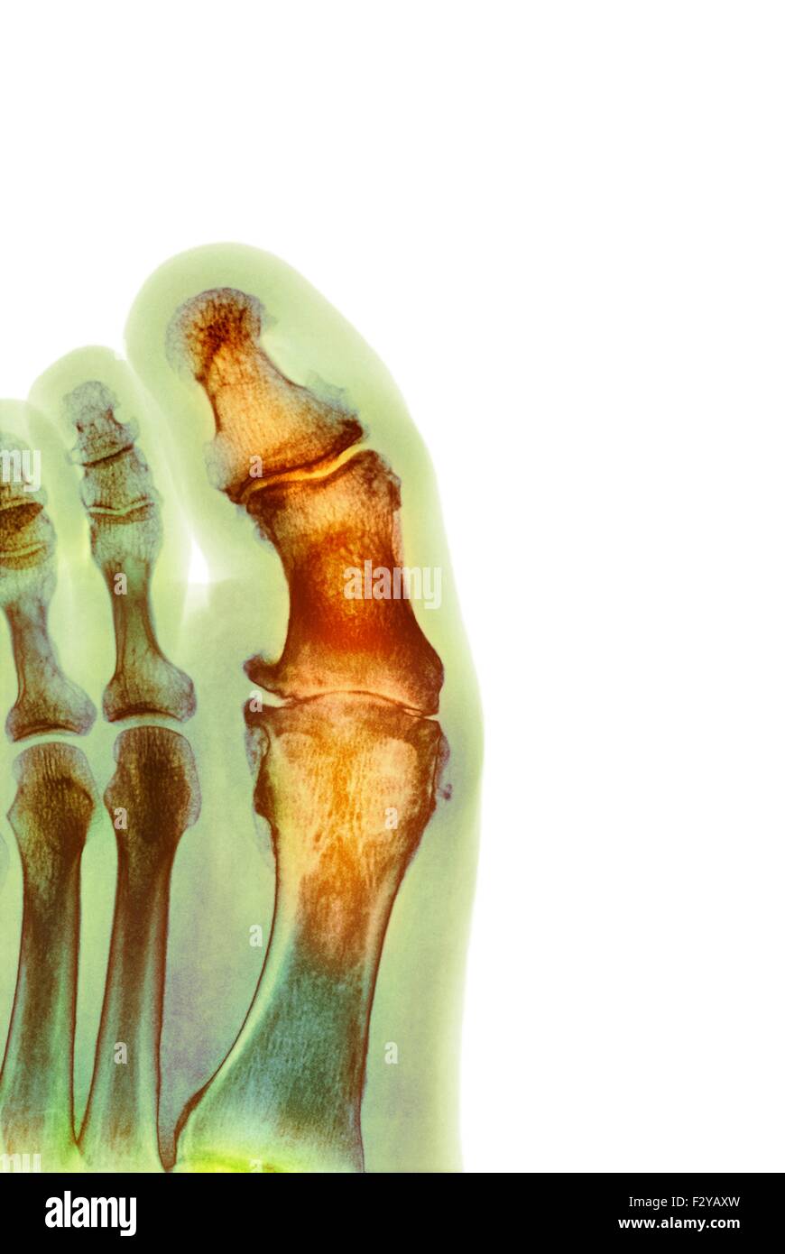 Degenerative deformazione del piede. Colorato X-ray di una sezione attraverso il piede di un 66-anno-vecchio paziente di sesso maschile con un grave cambiamento degenerativa nel metatarsophalangeal (MTP) comune di alluce (centro). Il protocollo MTP giunti sono le articolazioni tra le ossa metatarsali del piede e le ossa prossimali (prossimale) delle falangi delle dita. Foto Stock