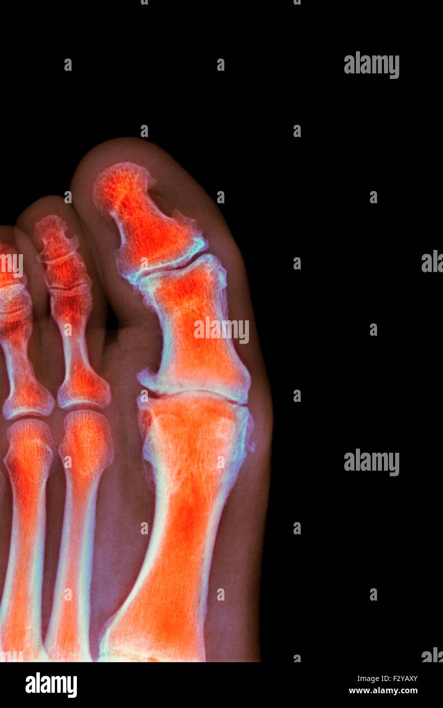Degenerative deformazione del piede. Colorato X-ray di una sezione attraverso il piede di un 66-anno-vecchio paziente di sesso maschile con un grave cambiamento degenerativa nel metatarsophalangeal (MTP) comune di alluce (centro). Il protocollo MTP giunti sono le articolazioni tra le ossa metatarsali del piede e le ossa prossimali (prossimale) delle falangi delle dita. Foto Stock