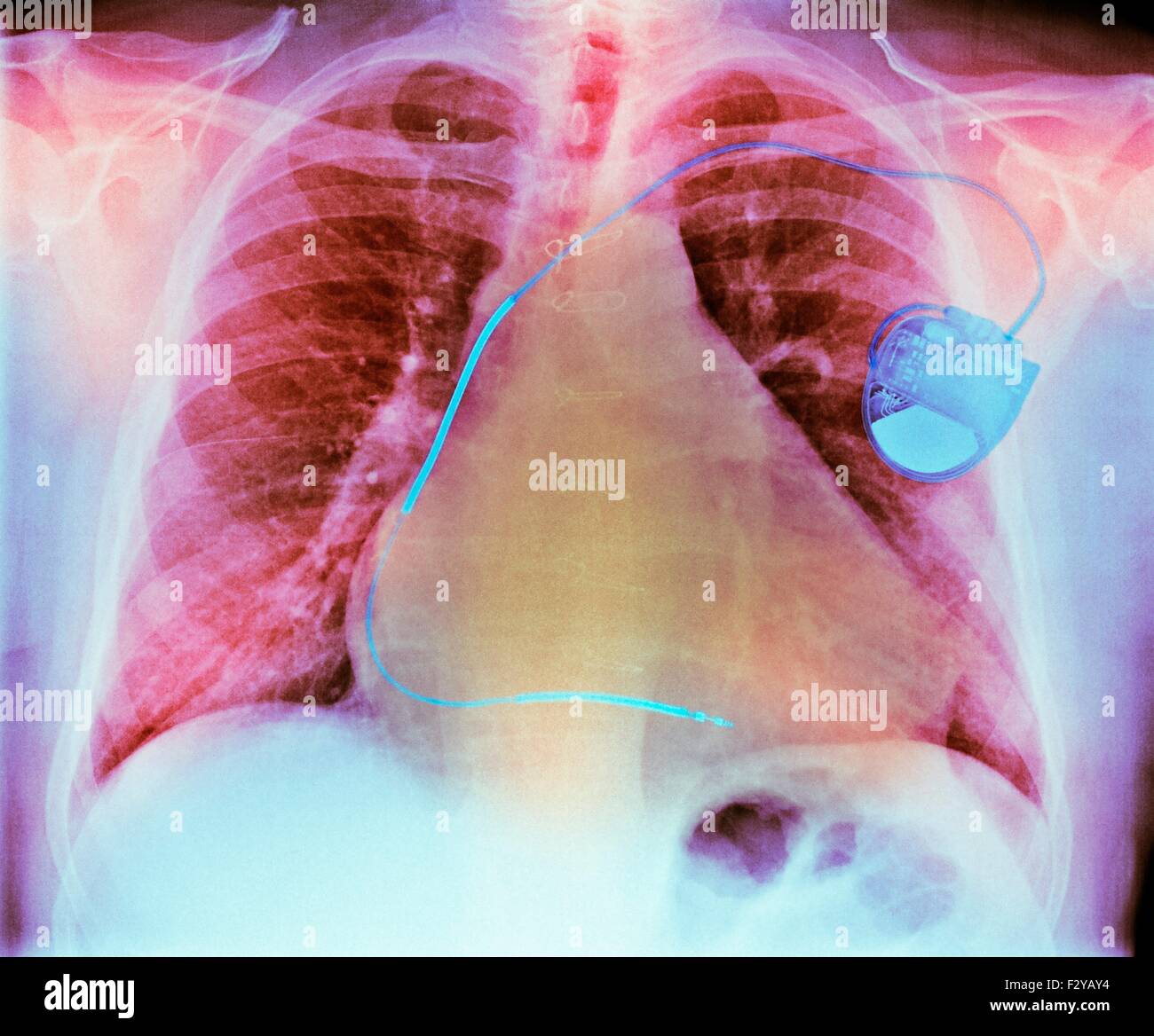 Pacemaker nella malattia di cuore. Colorato i raggi X al torace che mostra un pacemaker (destra) montato su un 73-anno-vecchio paziente di sesso maschile con un ingrandimento di un cuore (cardiomegaly) di fibrillazione atriale, malattia cardiaca ischemica e malattia polmonare ostruttiva cronica (COPD). Un pacemaker fornisce impulsi elettrici al cuore per mantenere il battito cardiaco a un ritmo regolare. Esso può essere esterna (indossato su una cintura) o interno (impiantato nel petto, come qui). Foto Stock