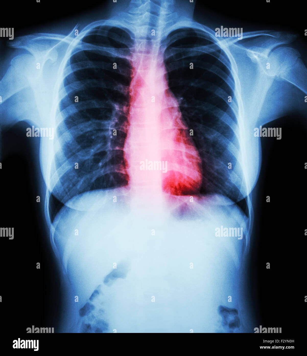 La malattia di cuore ( pellicola i raggi x al torace della donna con la  malattia di cuore Foto stock - Alamy