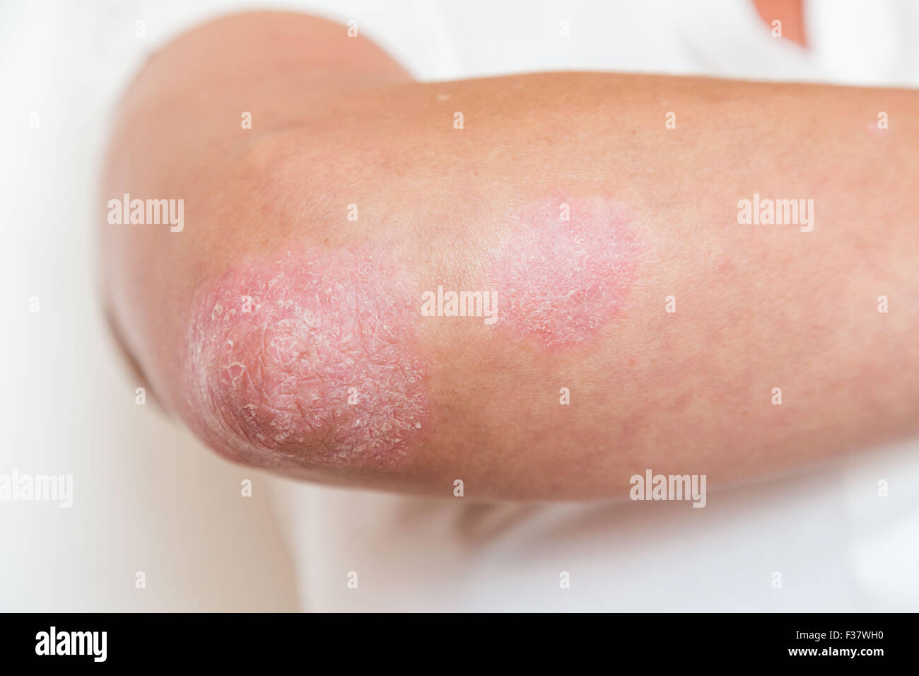 Psoriasi. Foto Stock