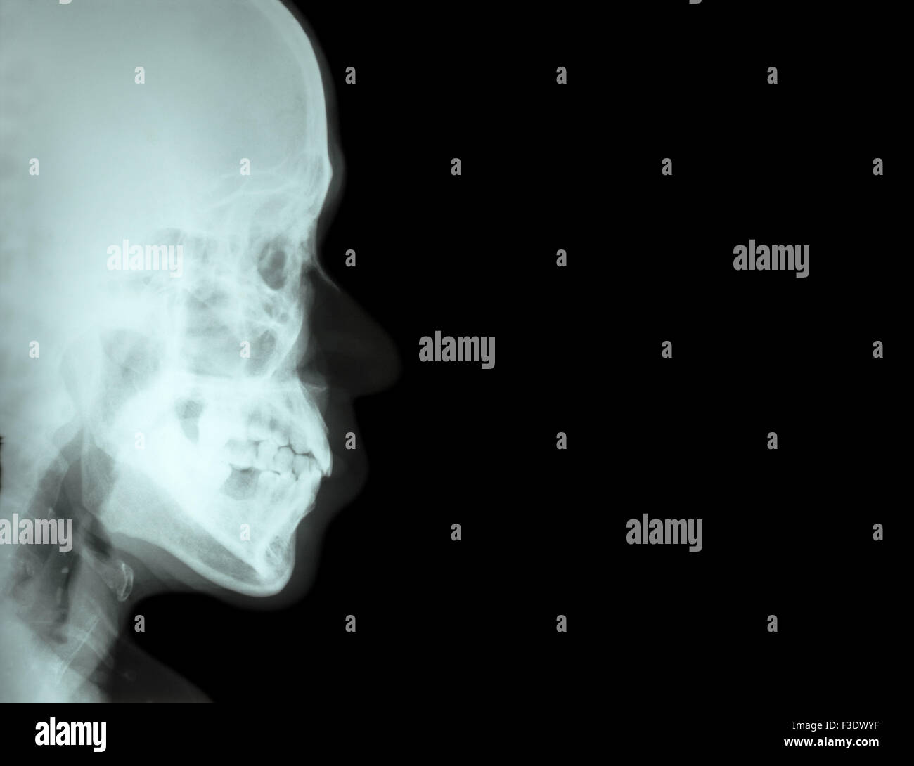 Film X-ray laterali osso nasale ( vista laterale del cranio ) e la zona vuota a destra Foto Stock