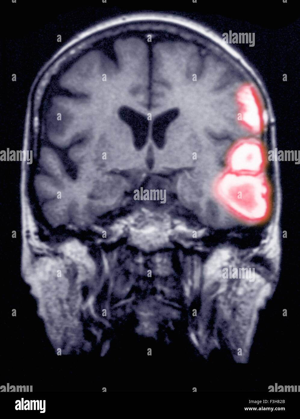 Temporoparietal emorragia cerebrale in 77 anni femmina mostrato su una scansione in MRI Foto Stock
