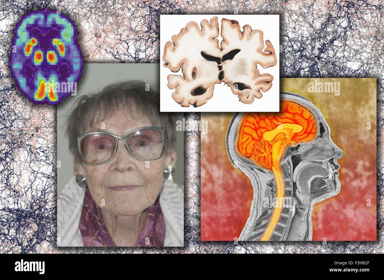 Senior donna morbo di Alzheimer illustrazione Foto Stock