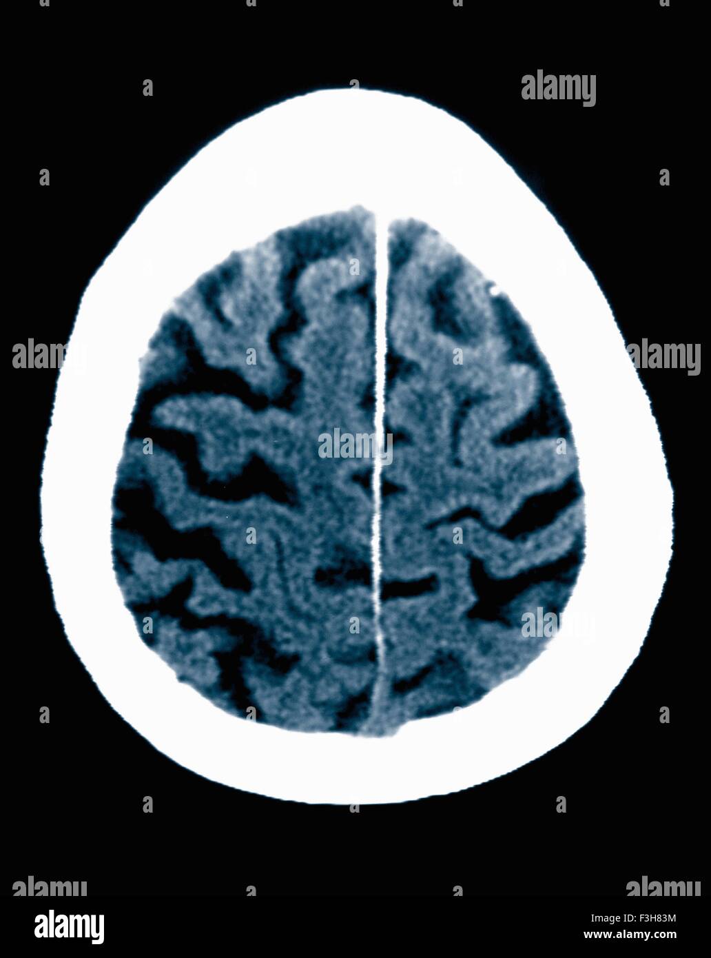 Scansione TC 84 enne maschio con la malattia di Alzheimer. CT mostra atrofia cerebrale con gyri piccoli e grandi sulci Foto Stock