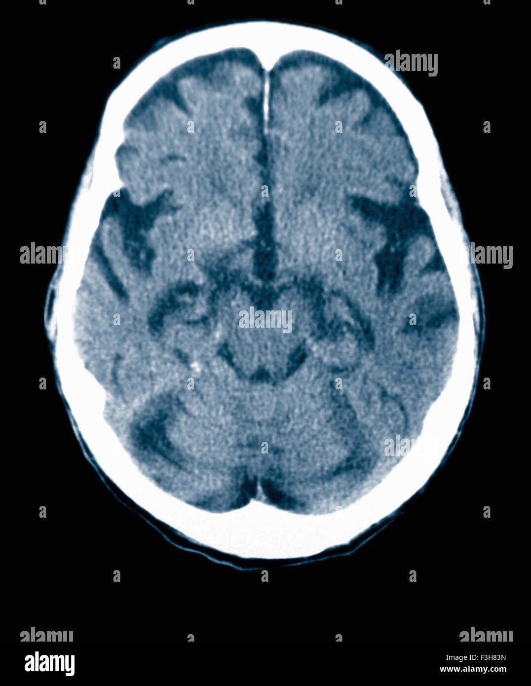 Scansione TC 84 enne maschio con la malattia di Alzheimer. CT mostra atrofia cerebrale con gyri piccoli e grandi sulci Foto Stock