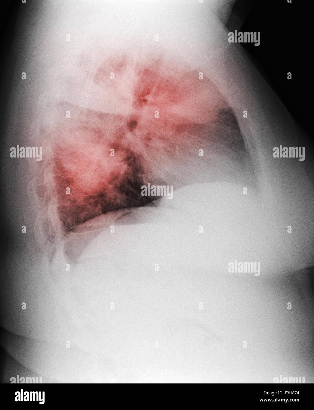 I raggi x al torace di una donna di 44 anni fumatore, mostra diffusa infiltrati interstiziali suggestivi di una polmonite atipica Foto Stock
