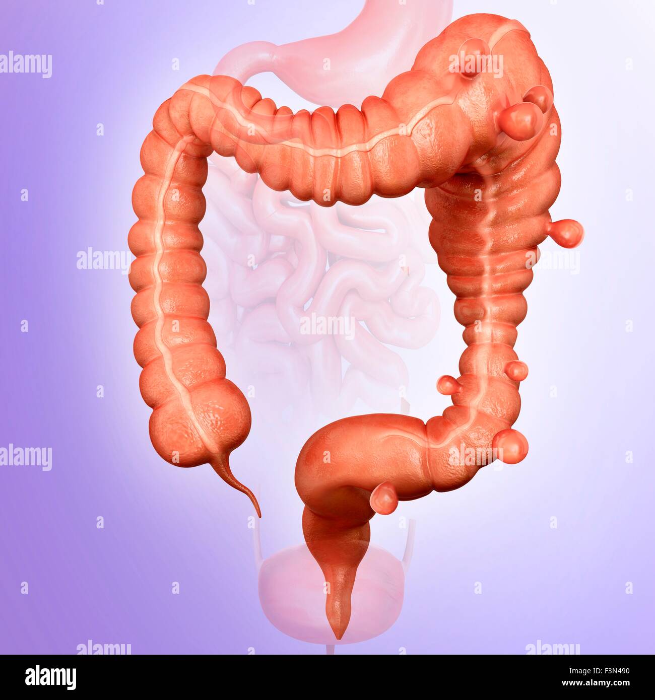 Megacolon e diverticolite Foto Stock