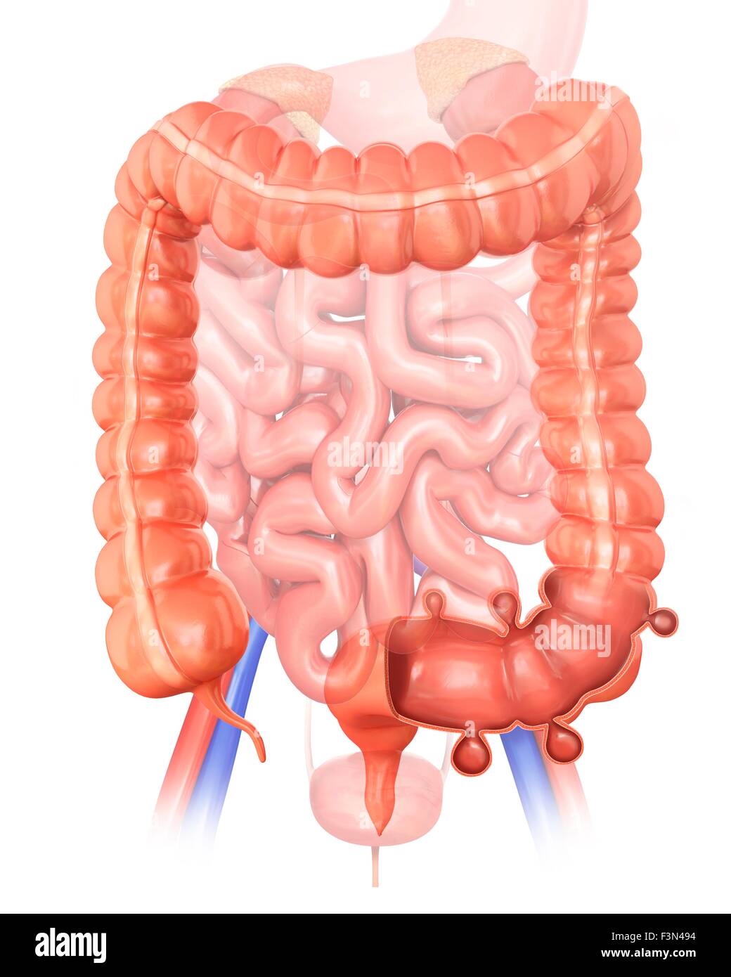 Diverticolosi, illustrazione Foto Stock