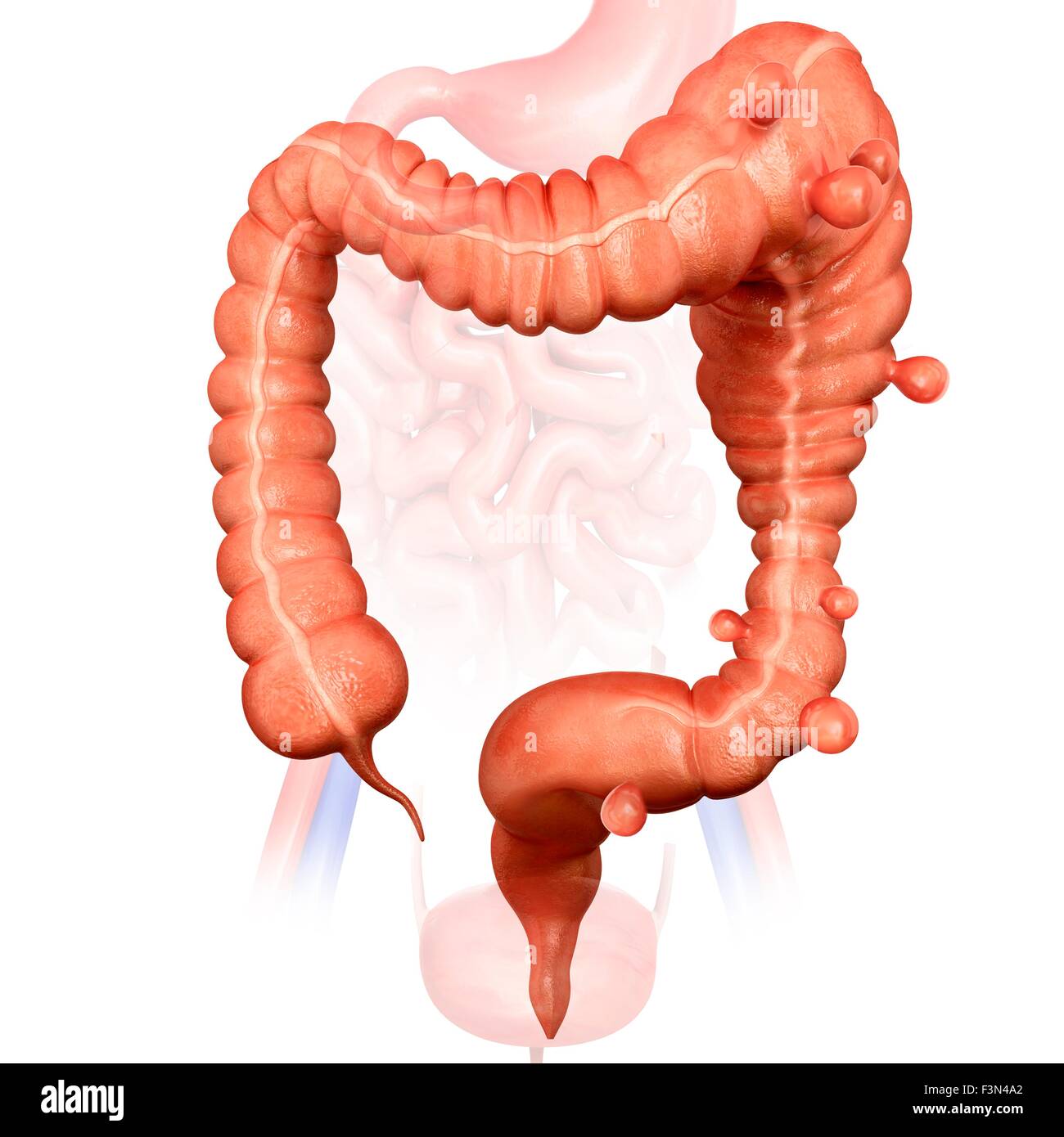 Megacolon e diverticolite Foto Stock