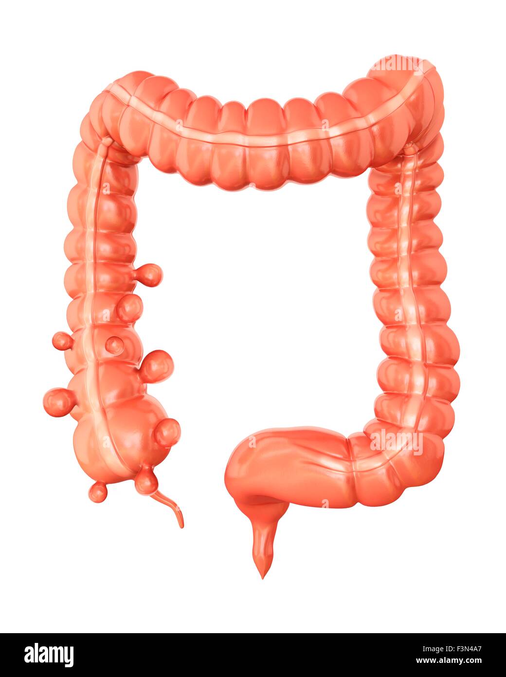 Diverticolosi, illustrazione Foto Stock