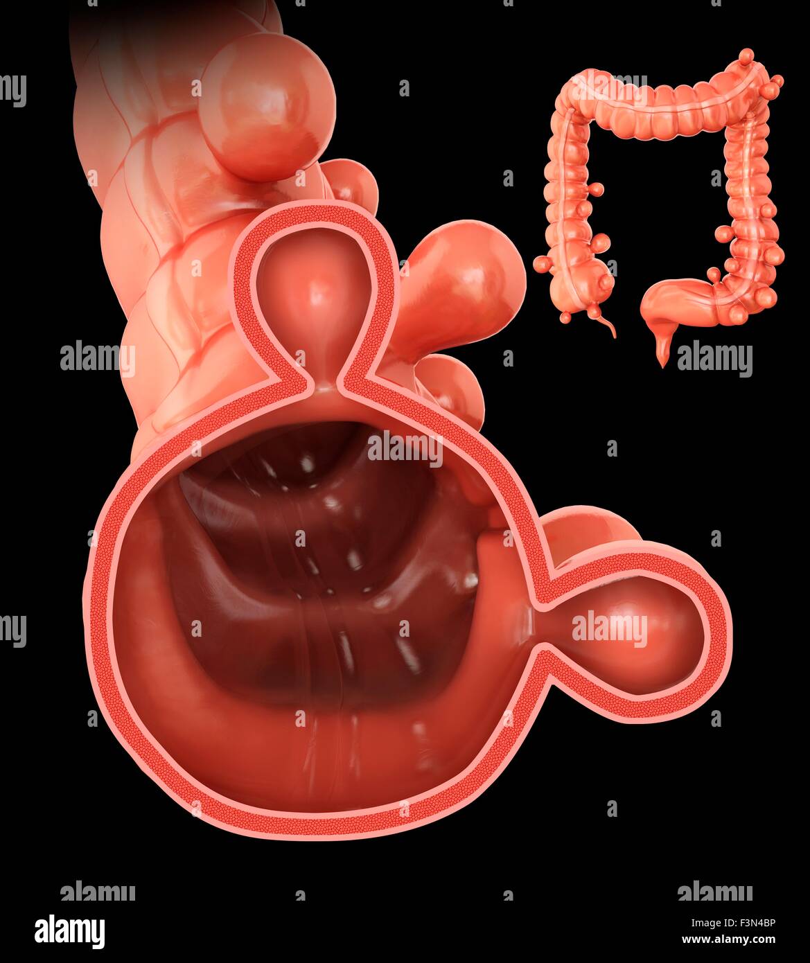 Diverticolosi, illustrazione Foto Stock