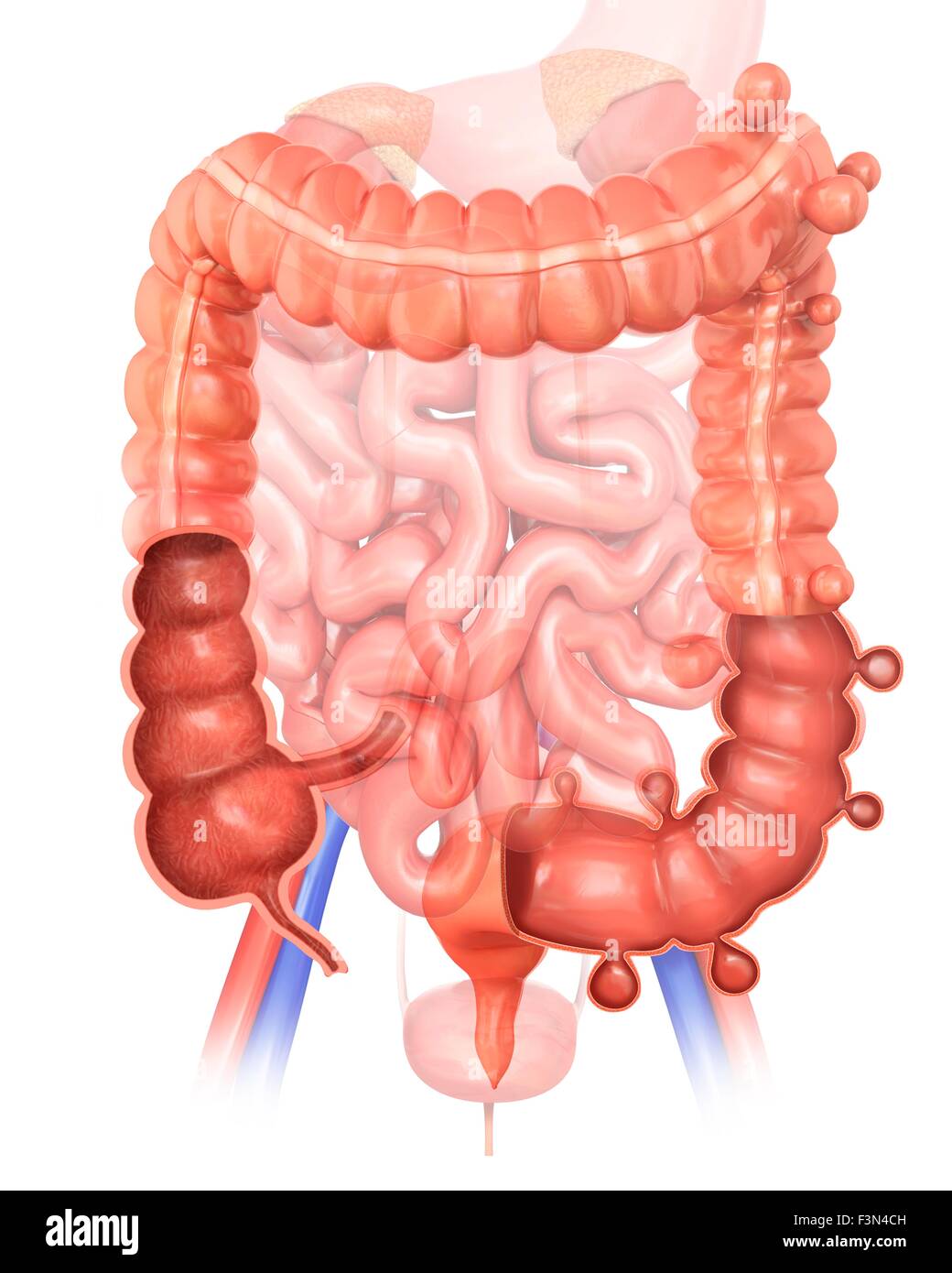 Diverticolosi, illustrazione Foto Stock