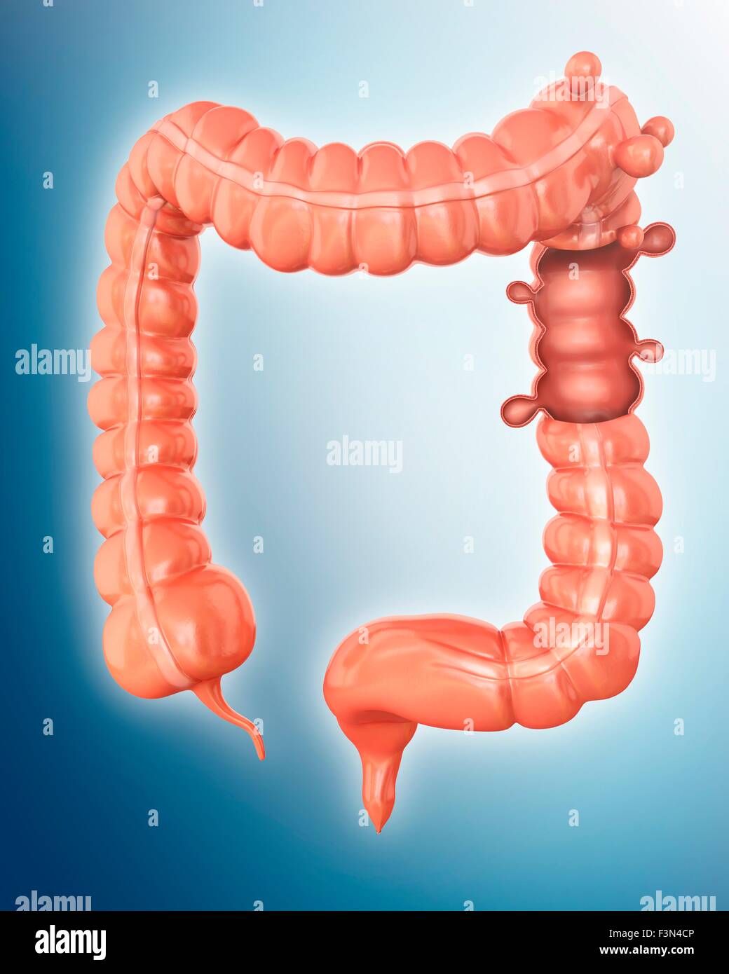 Diverticolosi, illustrazione Foto Stock