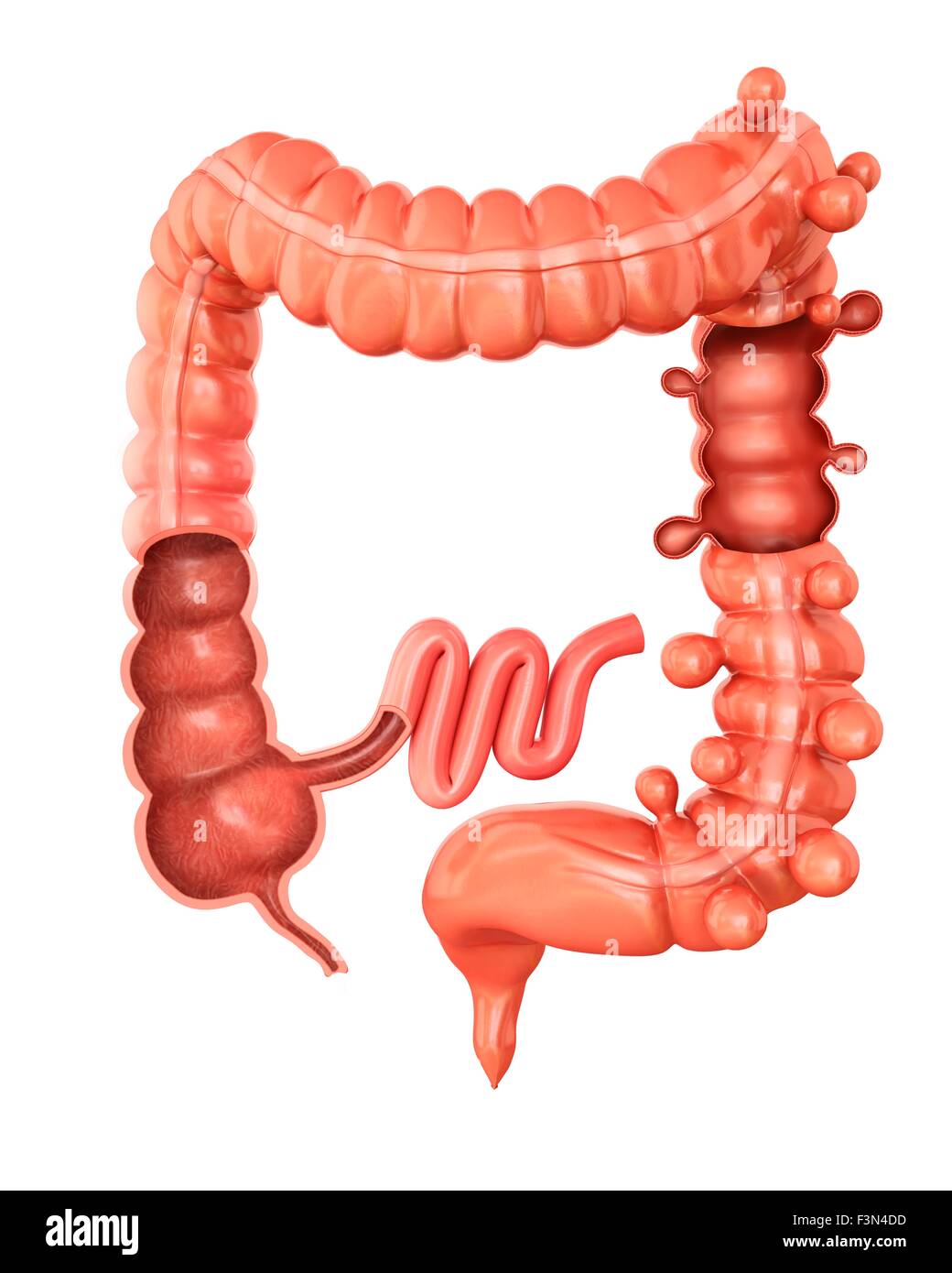 Diverticolosi, illustrazione Foto Stock