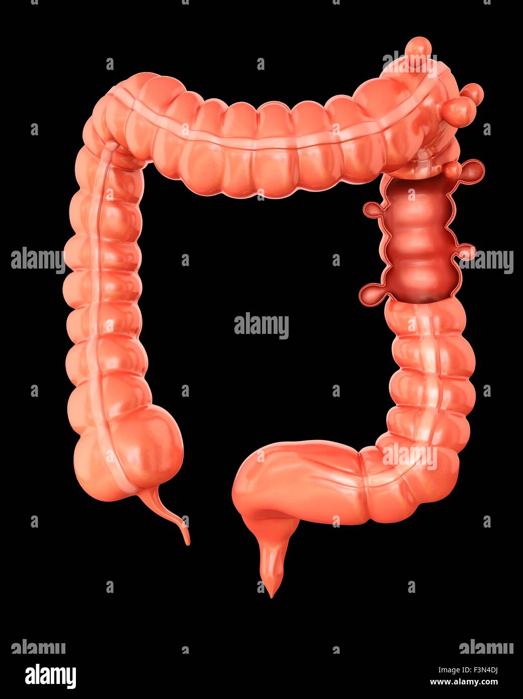 Diverticolosi, illustrazione Foto Stock