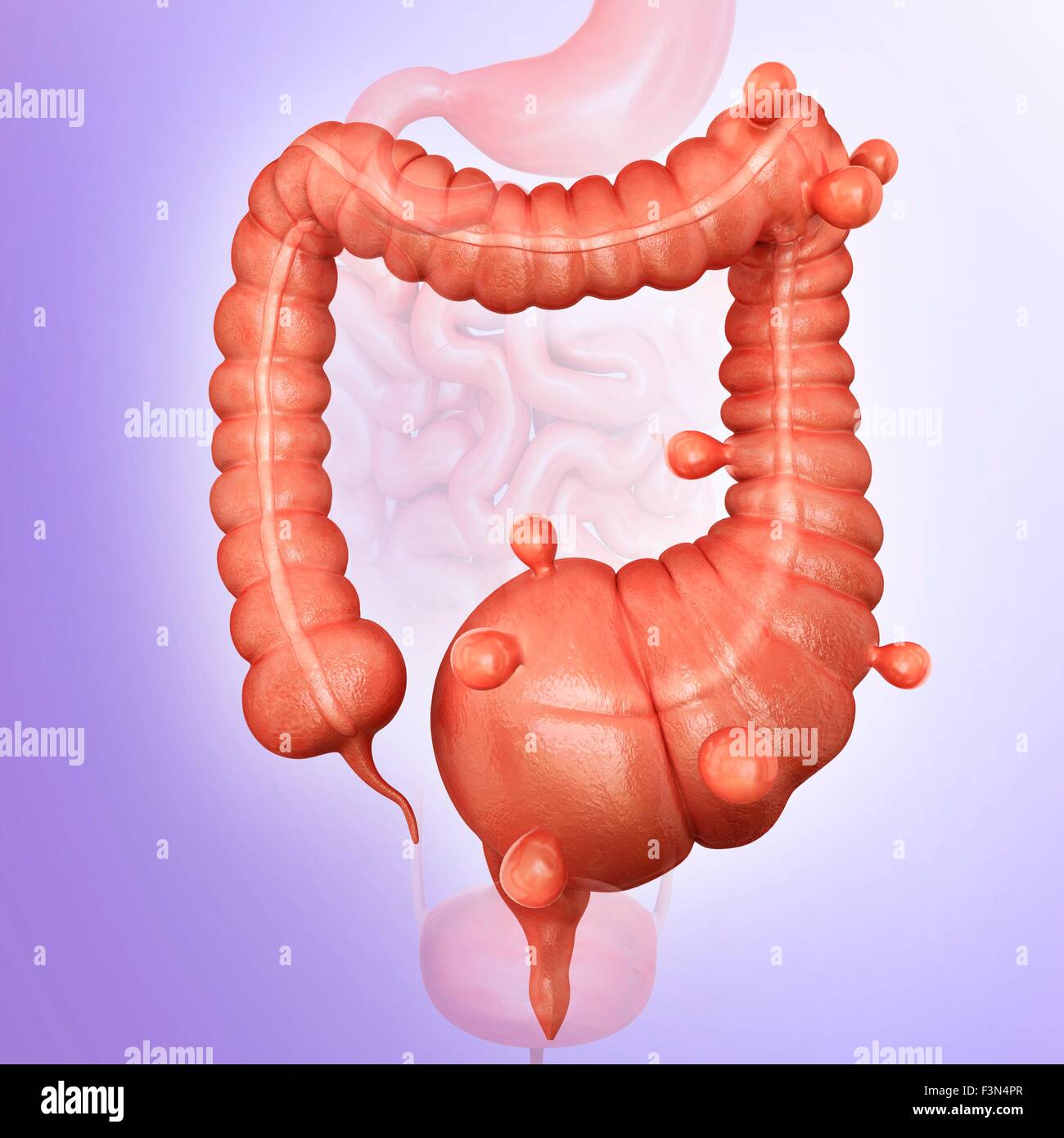 Diverticolosi, illustrazione Foto Stock