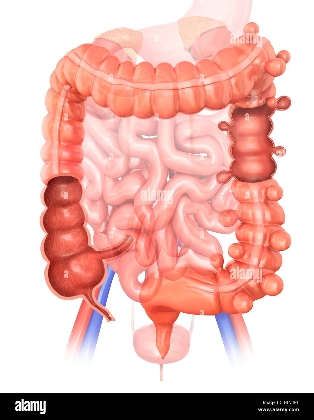 Diverticolosi, illustrazione Foto Stock