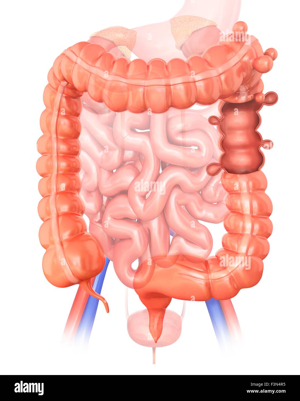 Diverticolosi, illustrazione Foto Stock