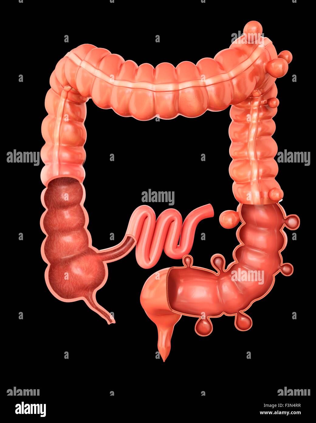 Diverticolosi, illustrazione Foto Stock