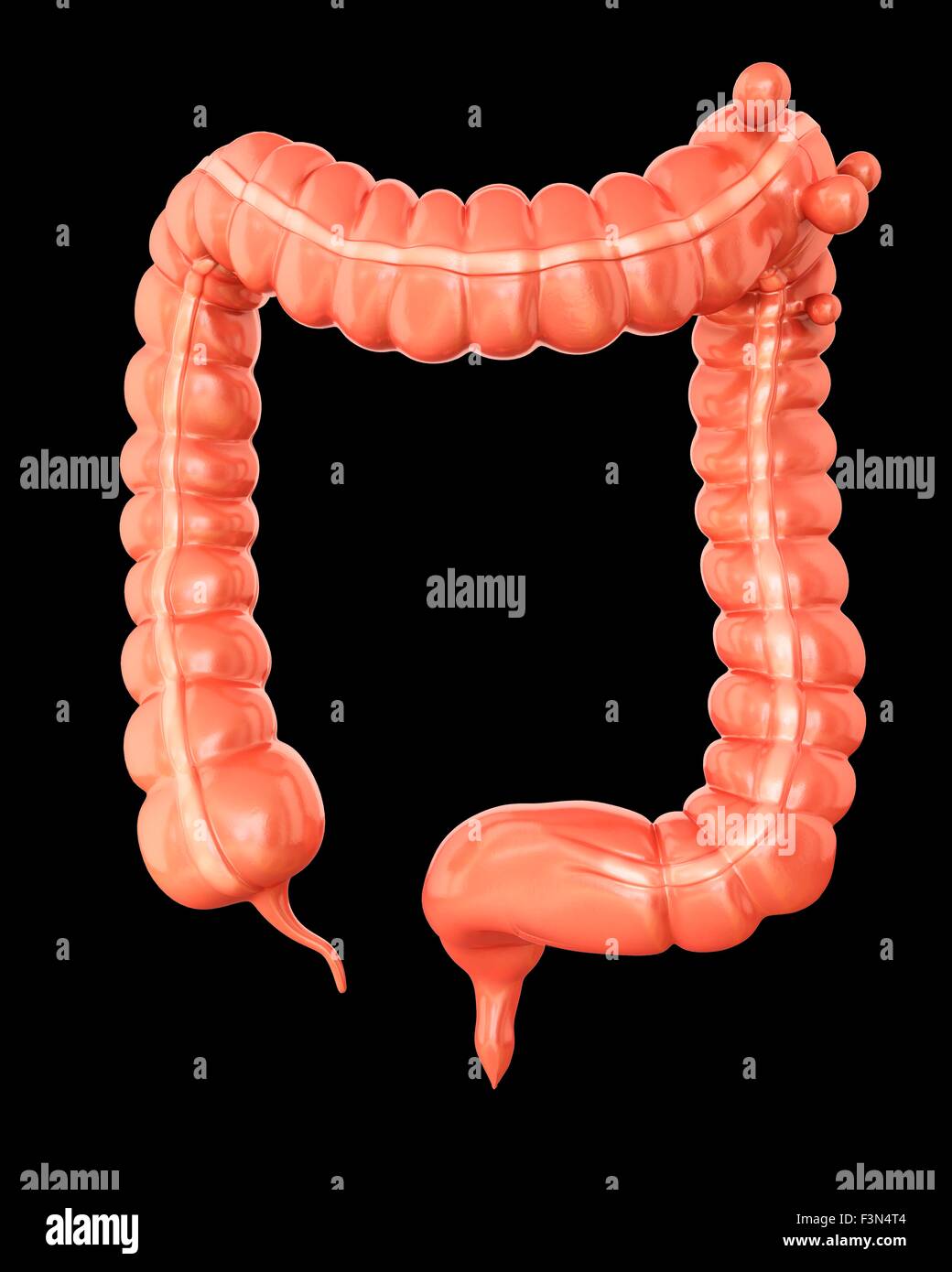 Diverticolosi, illustrazione Foto Stock