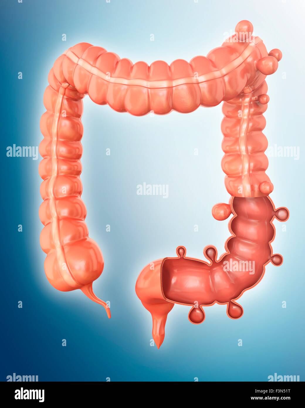 Diverticolosi, illustrazione Foto Stock