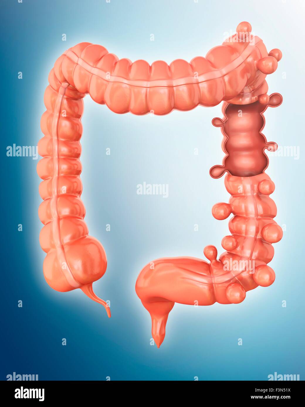 Diverticolosi, illustrazione Foto Stock