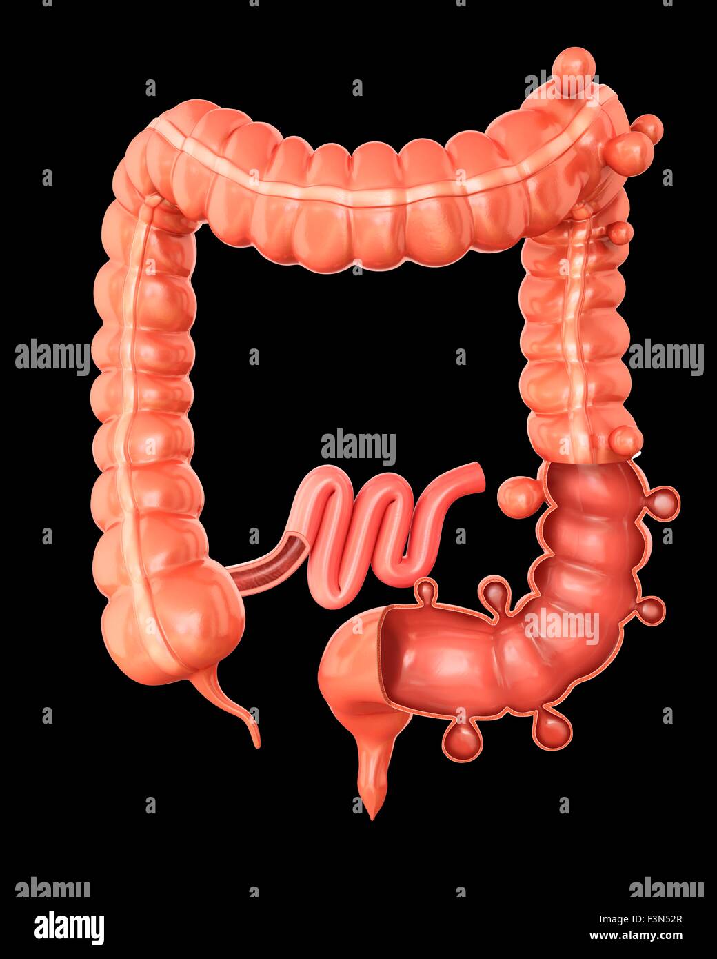 Diverticolosi, illustrazione Foto Stock