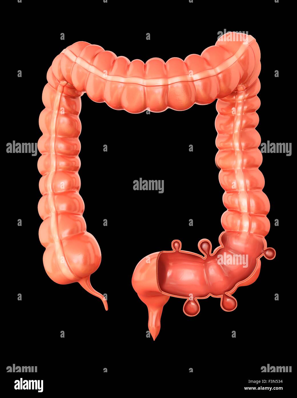 Diverticolosi, illustrazione Foto Stock
