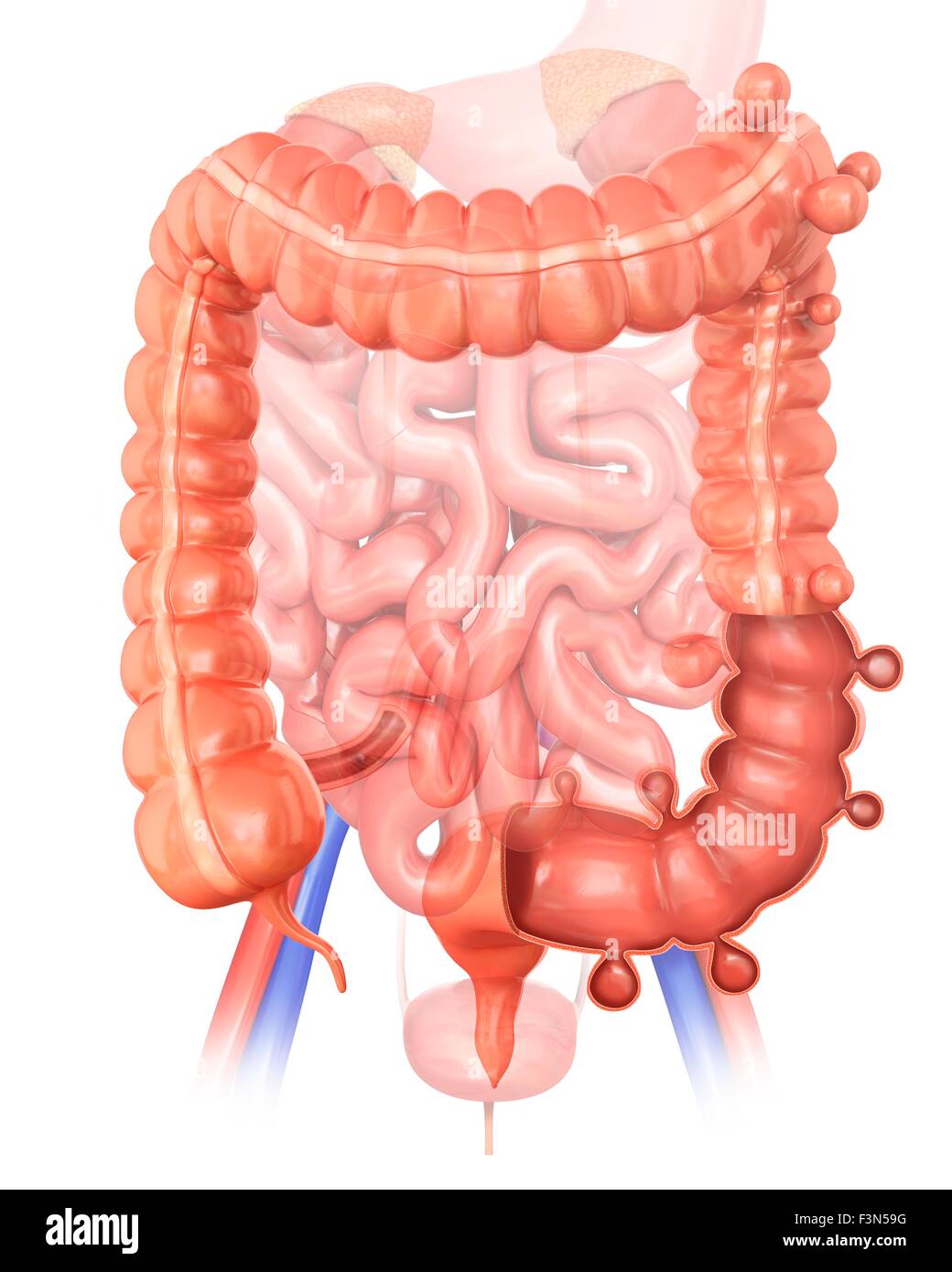 Diverticolosi, illustrazione Foto Stock