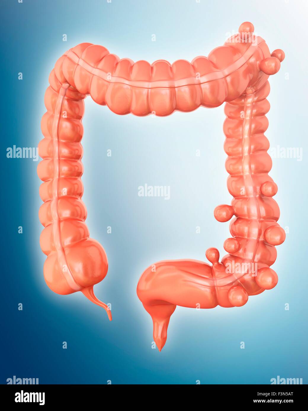 Diverticolosi, illustrazione Foto Stock