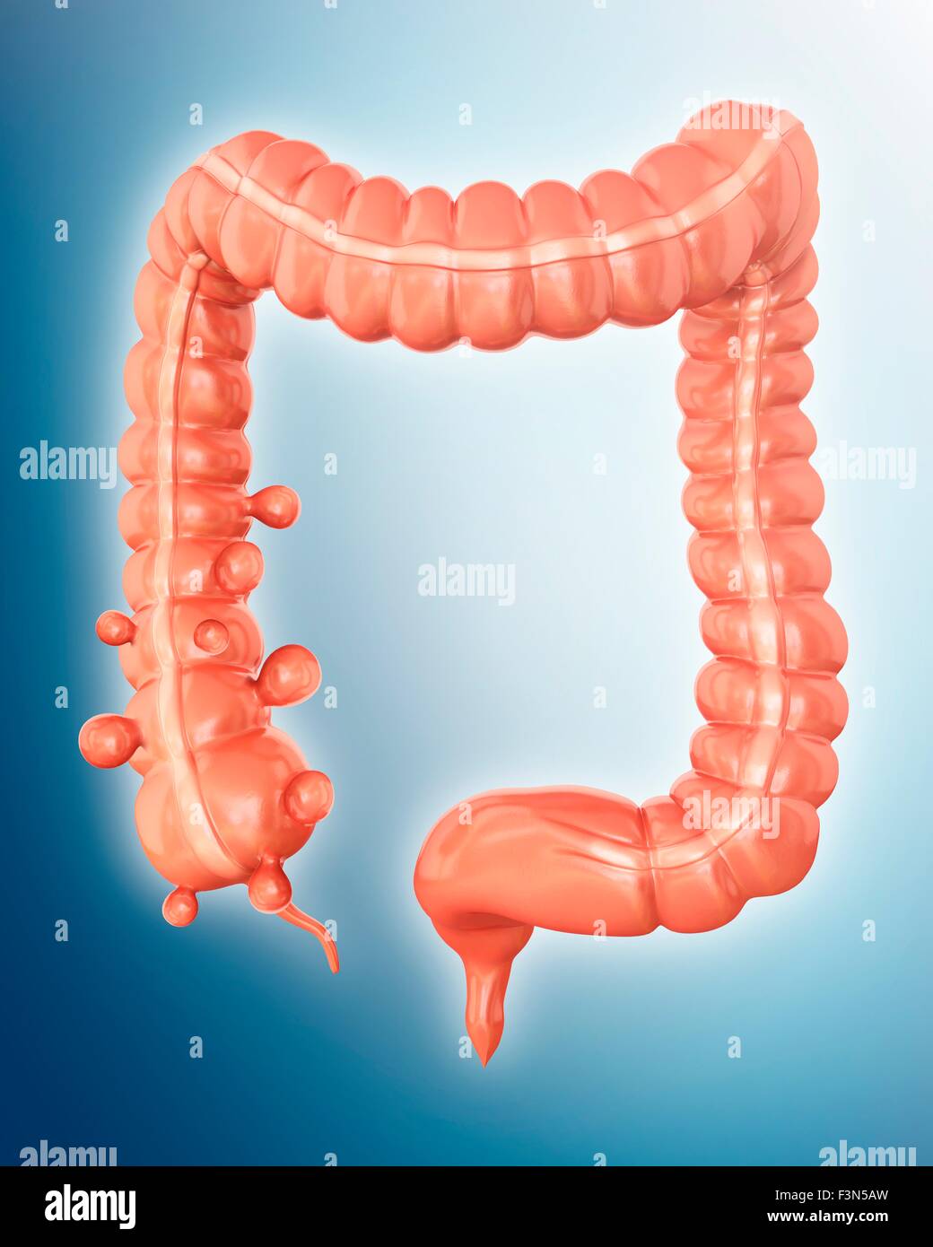 Diverticolosi, illustrazione Foto Stock
