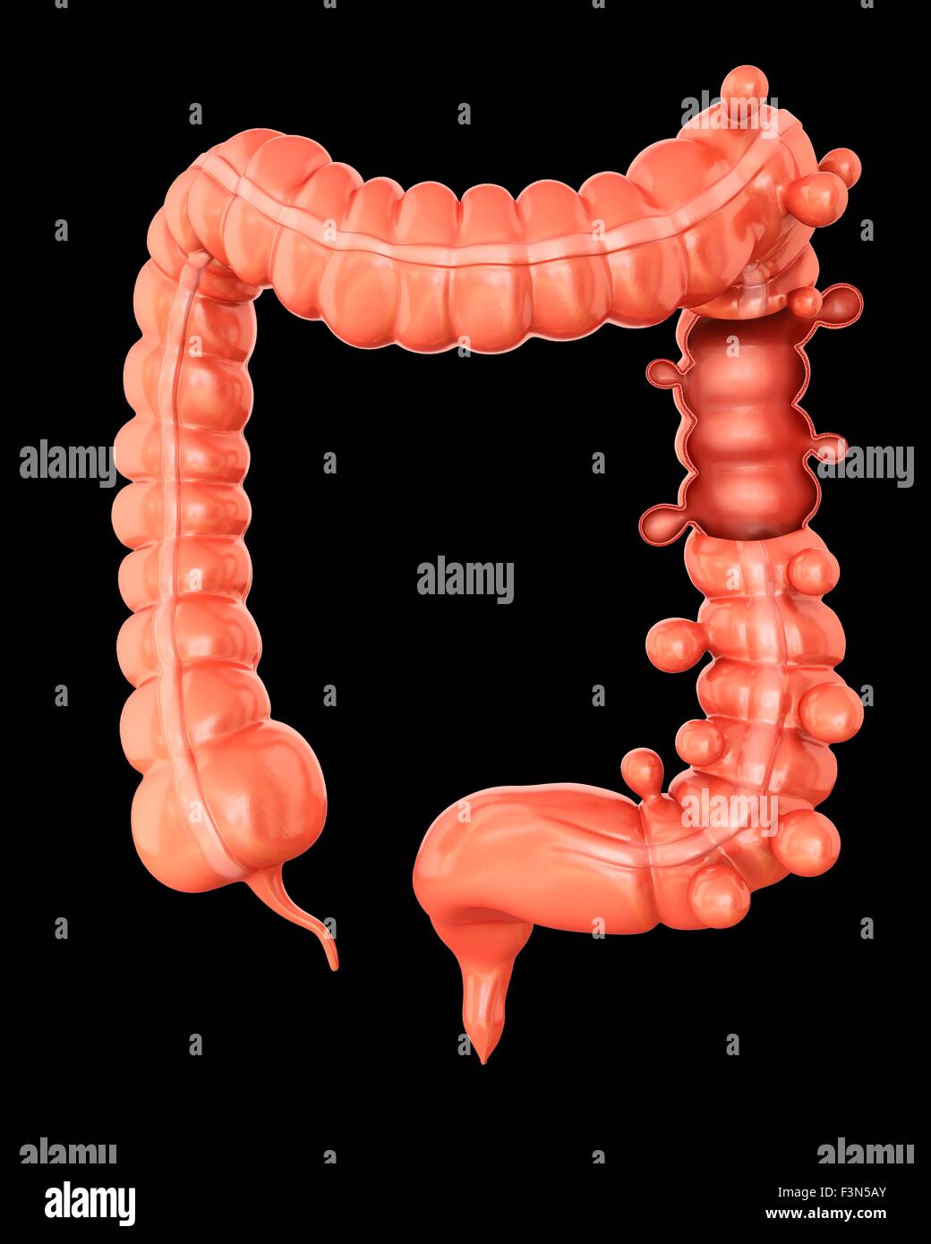 Diverticolosi, illustrazione Foto Stock