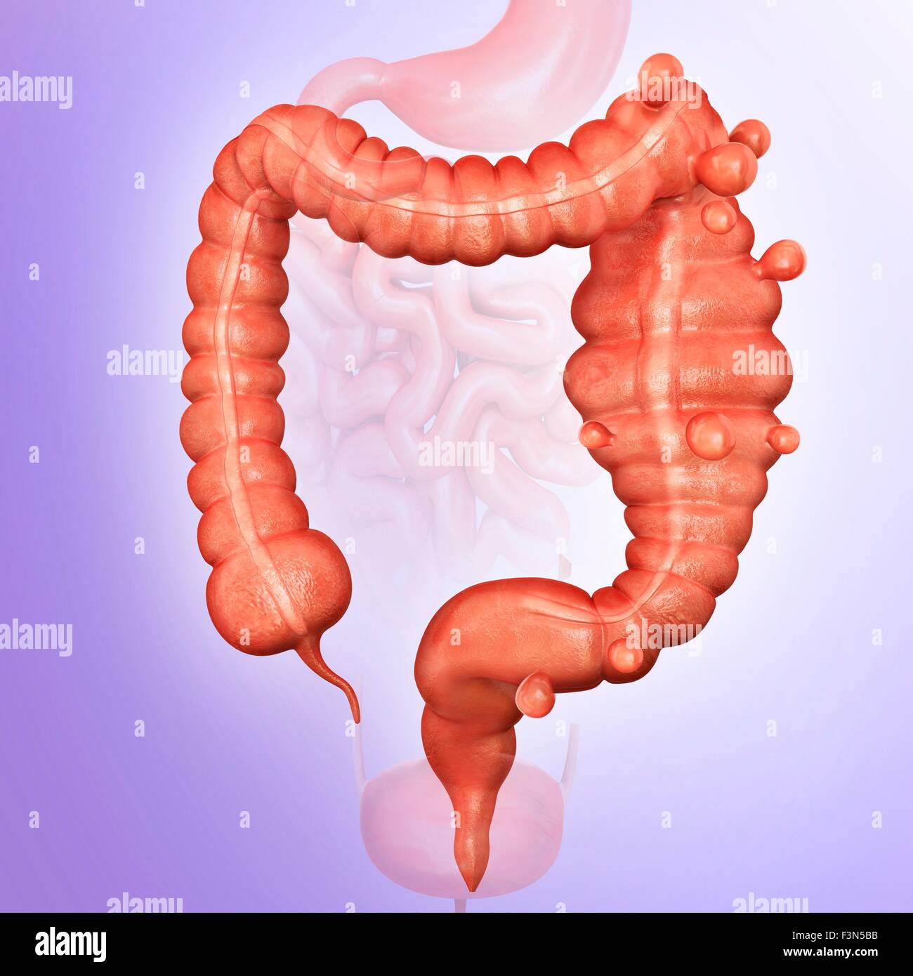 Megacolon e diverticolite Foto Stock