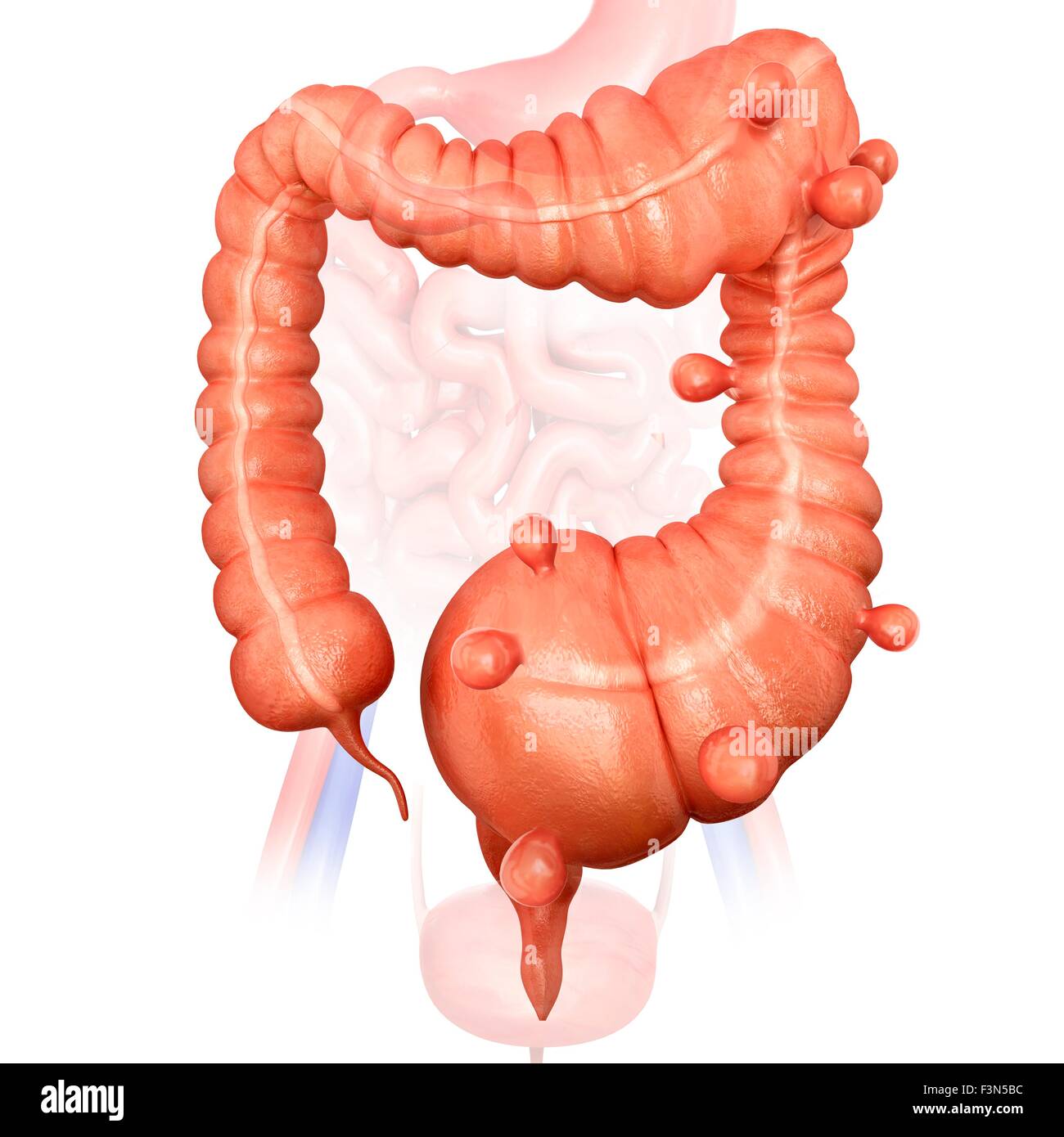 Megacolon e diverticolite Foto Stock