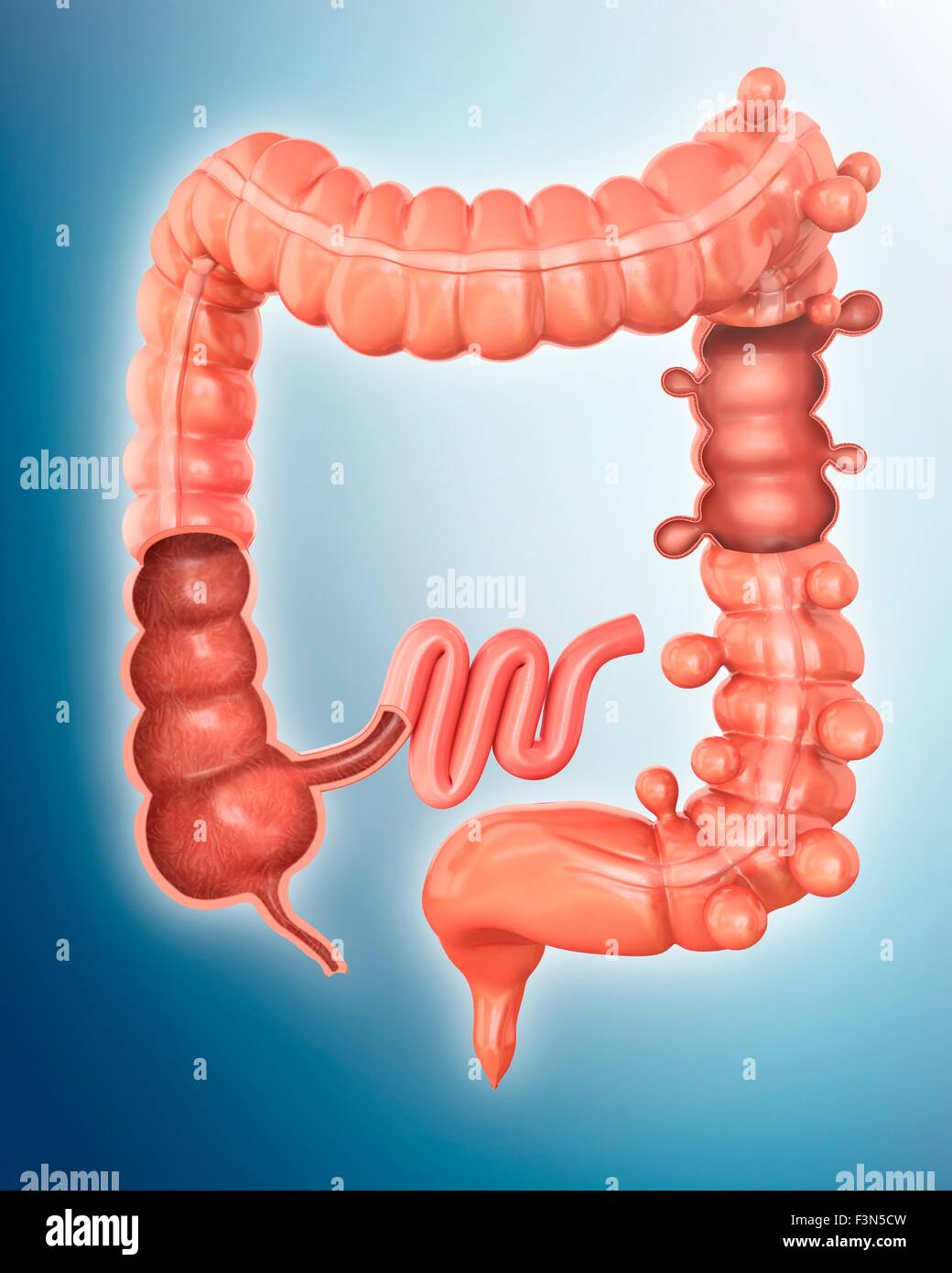Diverticolosi, illustrazione Foto Stock