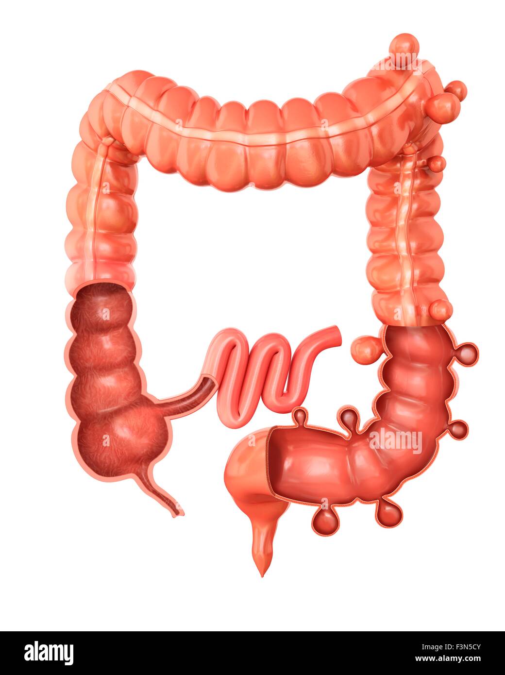 Diverticolosi, illustrazione Foto Stock