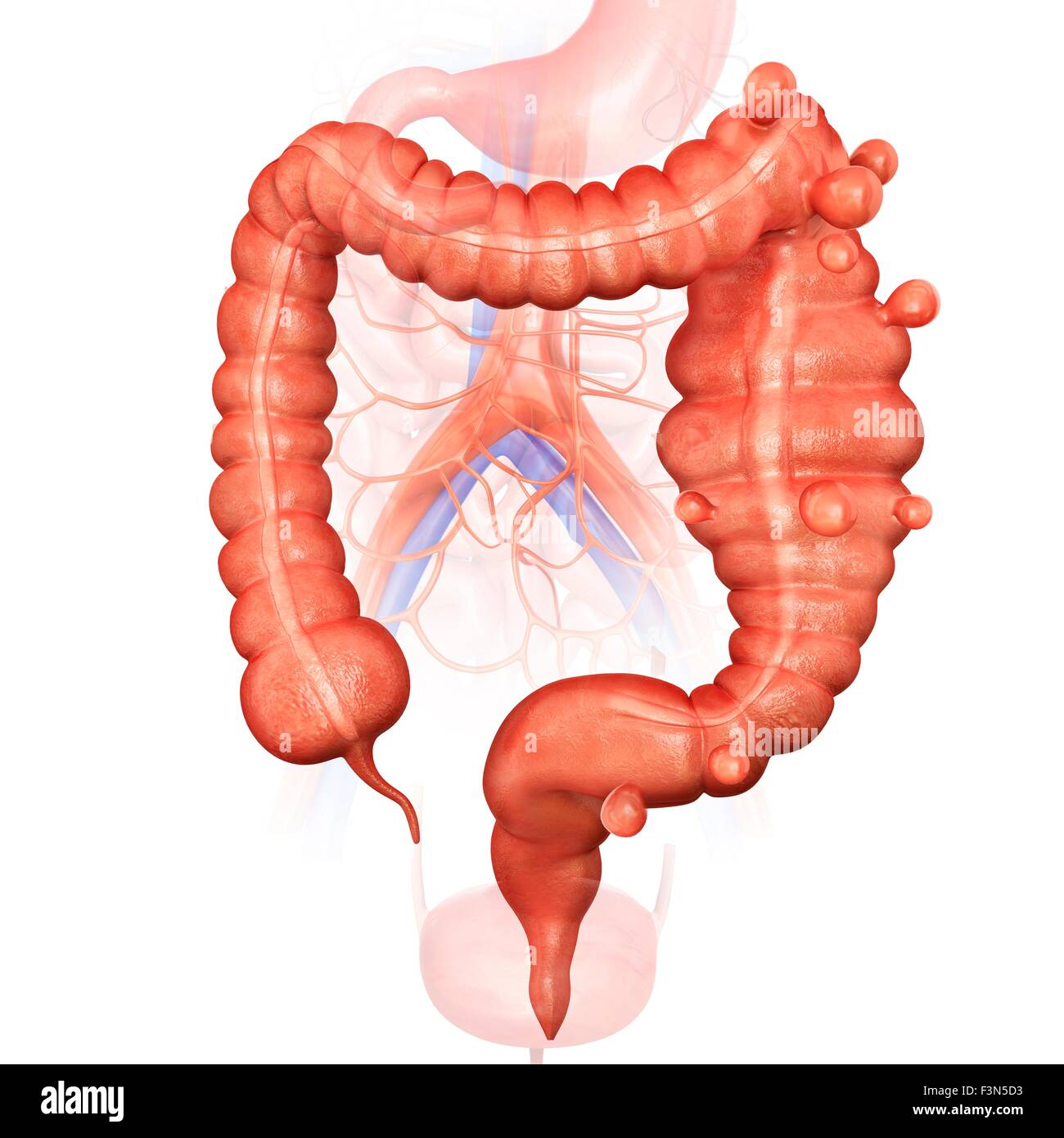 Megacolon e diverticolite Foto Stock