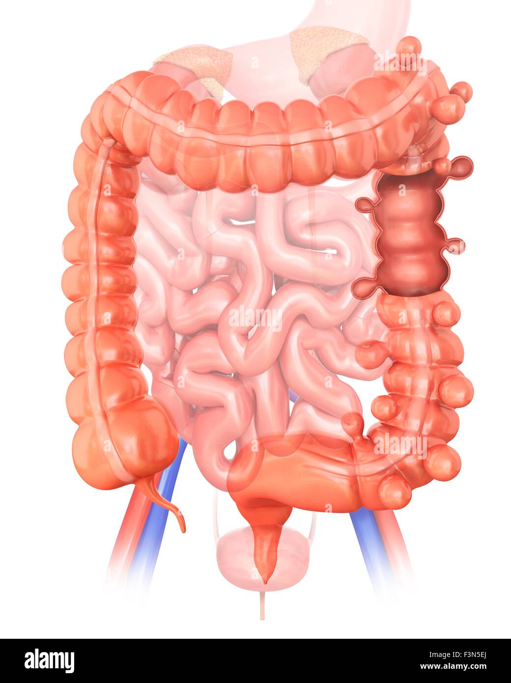 Diverticolosi, illustrazione Foto Stock
